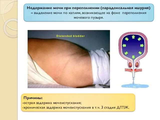 Недержание мочи при переполнении (парадоксальная ишурия) – выделение мочи по