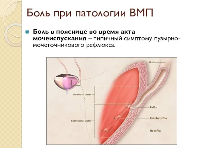 Боль при патологии ВМП Боль в пояснице во время акта мочеиспускания – типичный симптому пузырно-мочеточникового рефлюкса.