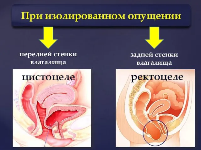 При изолированном опущении передней стенки влагалища задней стенки влагалища цистоцеле ректоцеле