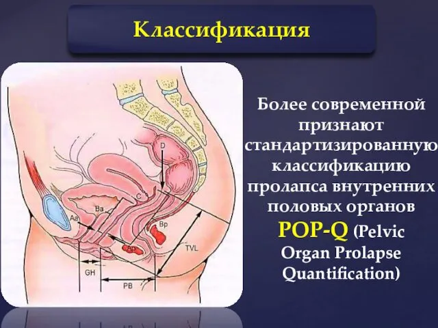 Классификация Более современной признают стандартизированную классификацию пролапса внутренних половых органов POP-Q (Pelvic Organ Prolapse Quantification)