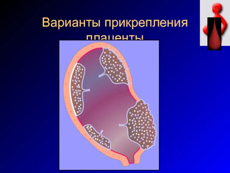 Варианты прикрепления плаценты