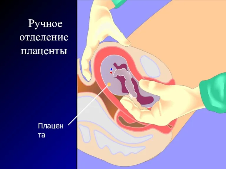 Ручное отделение плаценты Плацента