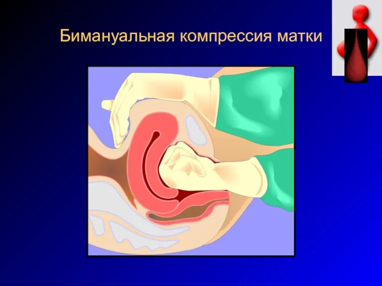 Бимануальная компрессия матки