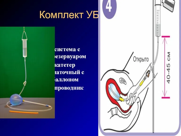 Комплект УБТ -система с резервуаром -катетер маточный с баллоном -проводник