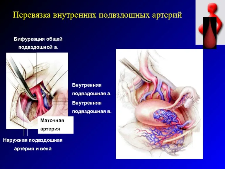 Внутренняя подвздошная а. Внутренняя подвздошная в. Маточная артерия Бифуркация общей