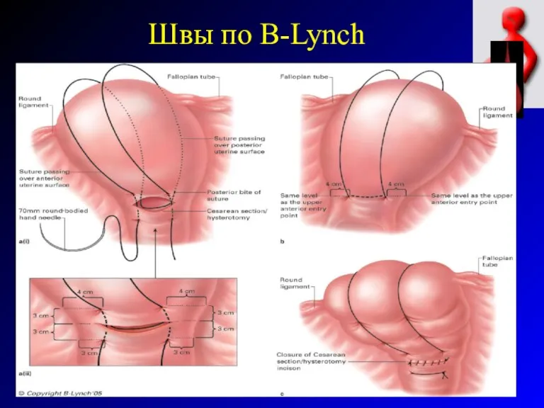 Швы по B-Lynch