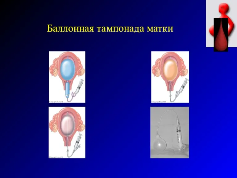 Баллонная тампонада матки