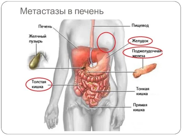 Метастазы в печень