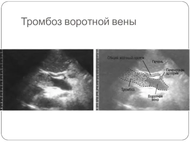 Тромбоз воротной вены