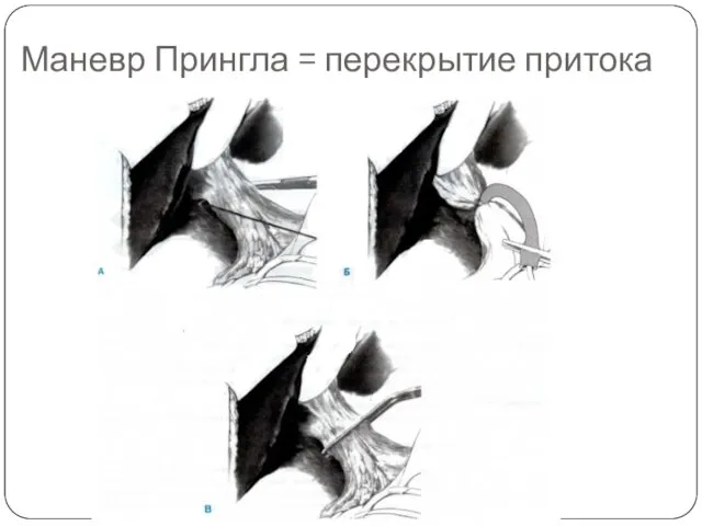 Маневр Прингла = перекрытие притока