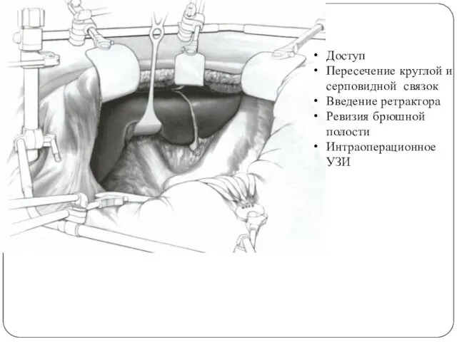 Доступ Пересечение круглой и серповидной связок Введение ретрактора Ревизия брюшной полости Интраоперационное УЗИ