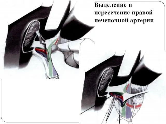 Выделение и пересечение правой печеночной артерии