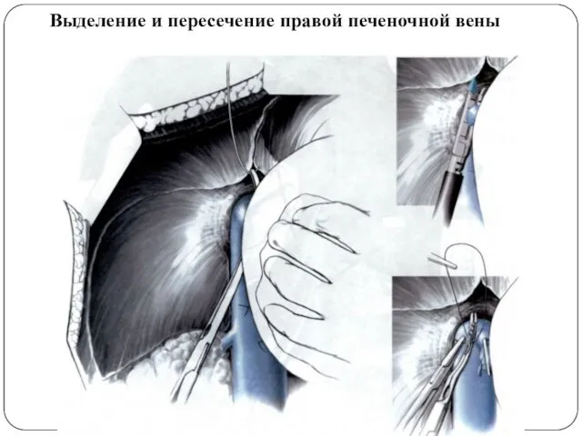 Выделение и пересечение правой печеночной вены