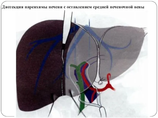 Диссекция паренхимы печени с оставлением средней печеночной вены