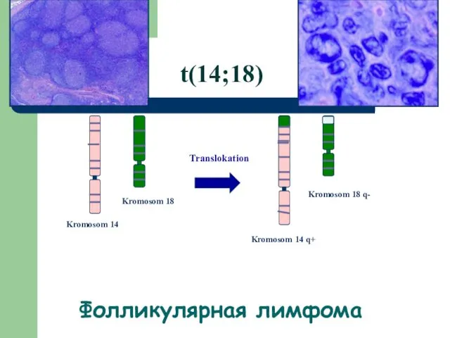 Kromosom 14 Kromosom 18 Kromosom 14 q+ Kromosom 18 q- Translokation t(14;18) Фолликулярная лимфома