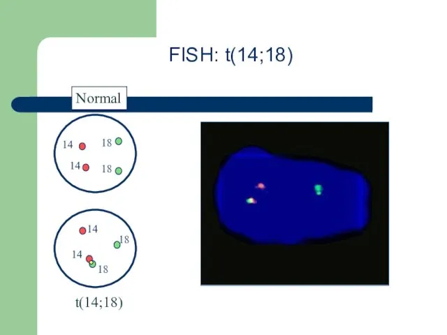 FISH: t(14;18) Normal t(14;18) 14 14 14 14 18 18 18 18