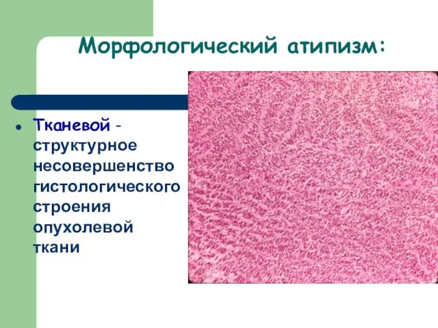 Морфологический атипизм: Тканевой - структурное несовершенство гистологического строения опухолевой ткани
