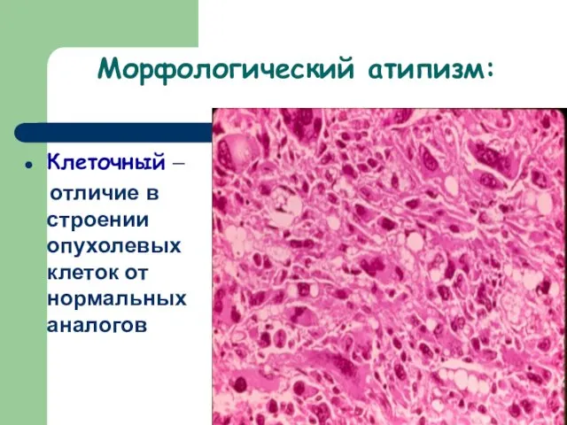 Морфологический атипизм: Клеточный – отличие в строении опухолевых клеток от нормальных аналогов