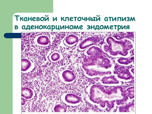 Тканевой и клеточный атипизм в аденокарциноме эндометрия