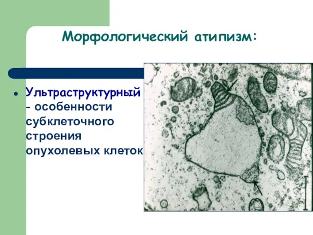 Морфологический атипизм: Ультраструктурный - особенности субклеточного строения опухолевых клеток