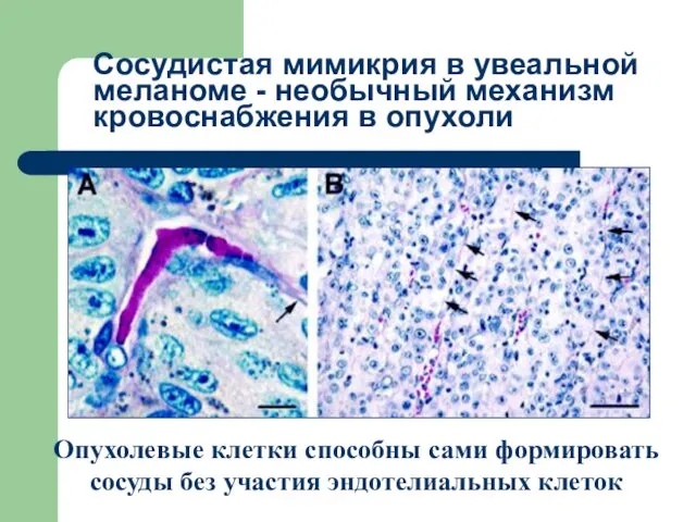 Сосудистая мимикрия в увеальной меланоме - необычный механизм кровоснабжения в опухоли Опухолевые клетки