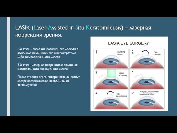 LASIK (Laser-Assisted in Situ Keratomileusis) – лазерная коррекция зрения. 1-й