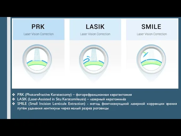 PRK (Photorefractive Keratectomy) – фоторефракционная кератэктомия LASIK (Laser-Assisted in Situ