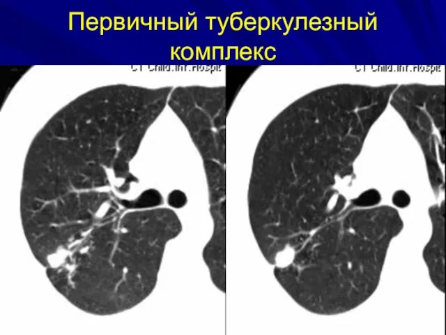 Первичный туберкулезный комплекс