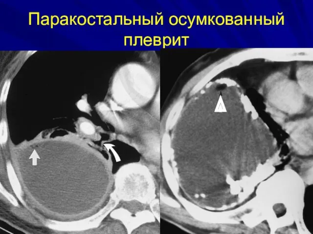 Паракостальный осумкованный плеврит