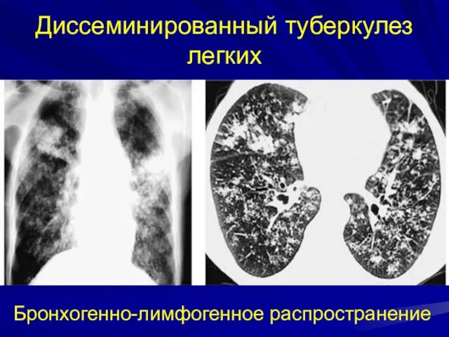 Диссеминированный туберкулез легких Бронхогенно-лимфогенное распространение