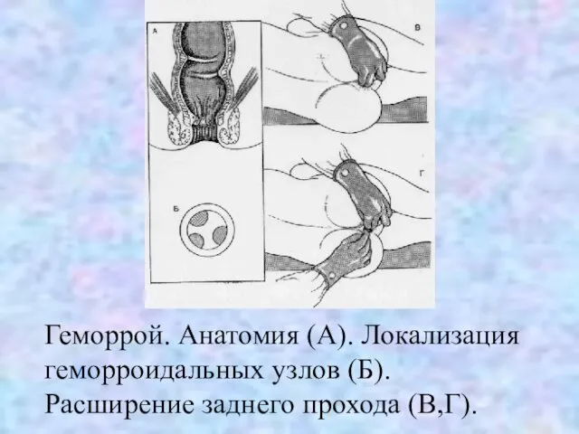 Геморрой. Анатомия (А). Локализация геморроидальных узлов (Б). Расширение заднего прохода (В,Г).