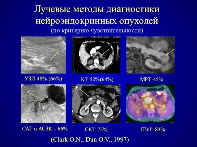 Лучевые методы диагностики нейроэндокринных опухолей (по критерию чувствительности) УЗИ-48% (66%)