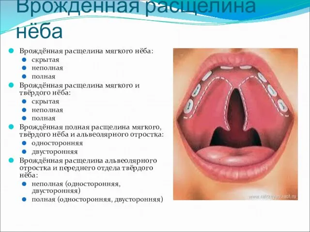 Врожденная расщелина нёба Врождённая расщелина мягкого нёба: скрытая неполная полная