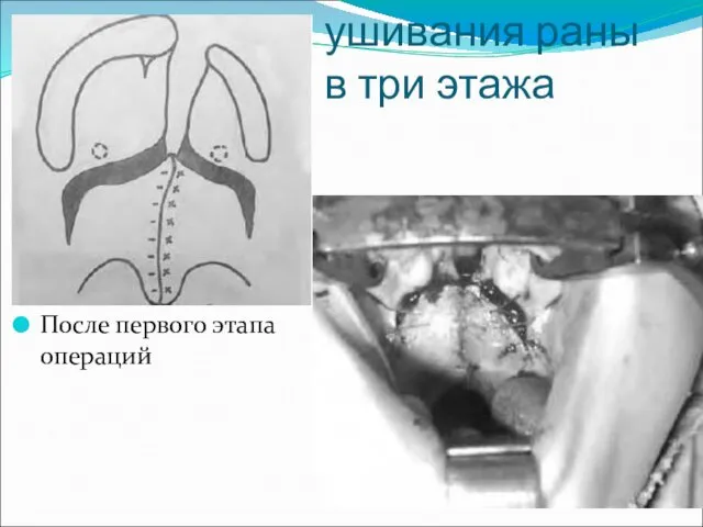 Схема ушивания раны в три этажа После первого этапа операций