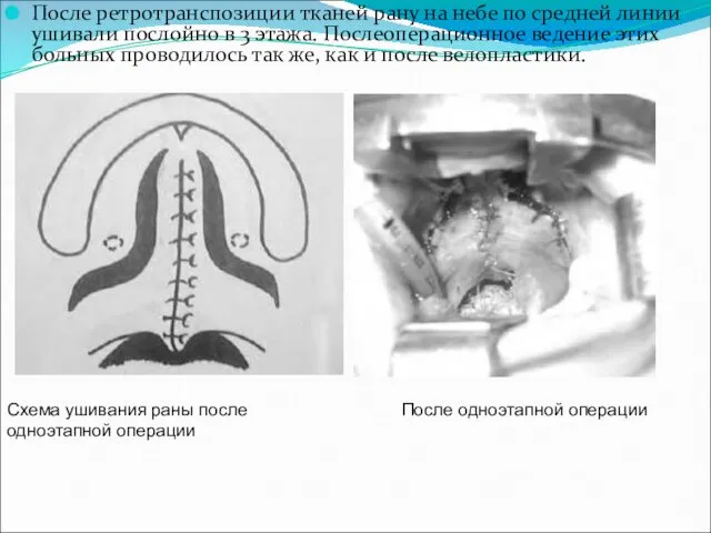 После ретротранспозиции тканей рану на небе по средней линии ушивали