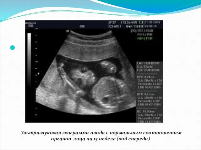 Ультразвуковая эхограмма плода с нормальным соотношением органов лица на 13 неделе (вид спереди)