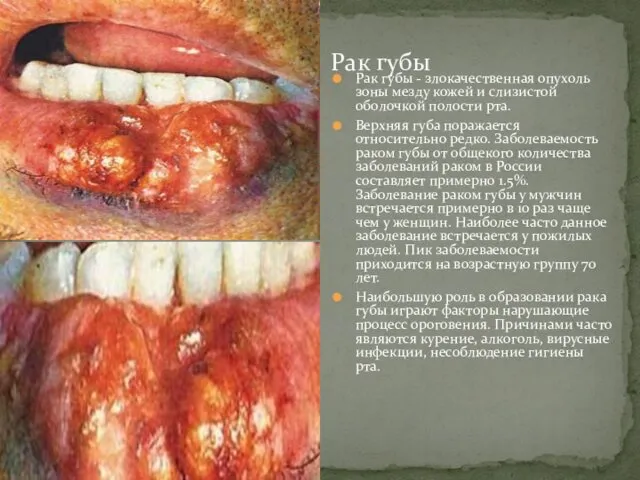 Рак губы - злокачественная опухоль зоны мезду кожей и слизистой