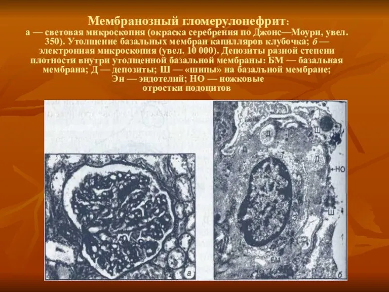 Мембранозный гломерулонефрит: а — световая микроскопия (окраска серебрения по Джонс—Моури, увел. 350). Утолщение