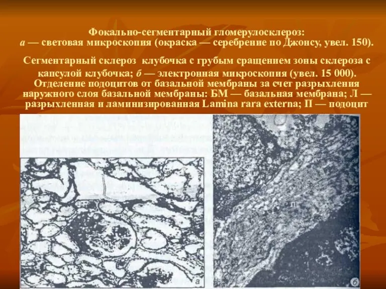 Фокально-сегментарный гломерулосклероз: a — световая микроскопия (окраска — серебрение по Джонсу, увел. 150).