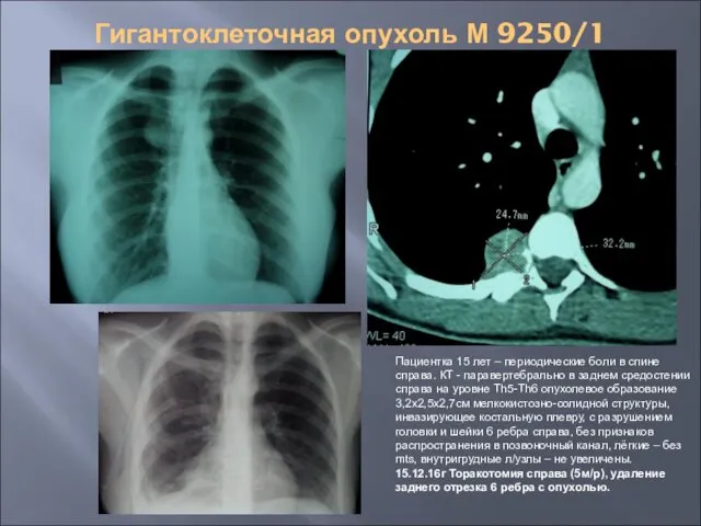 Гигантоклеточная опухоль М 9250/1 Пациентка 15 лет – периодические боли