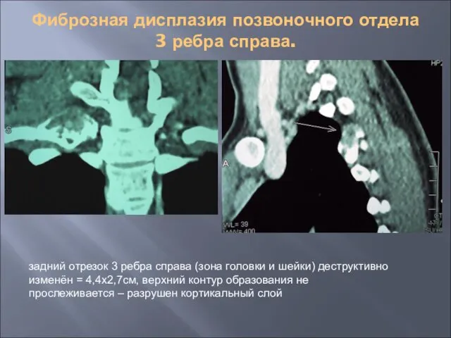 Фиброзная дисплазия позвоночного отдела 3 ребра справа. задний отрезок 3