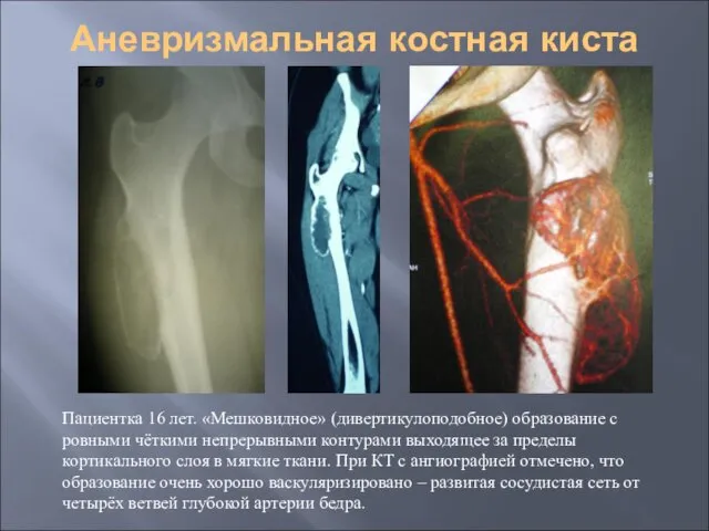 Аневризмальная костная киста Пациентка 16 лет. «Мешковидное» (дивертикулоподобное) образование с