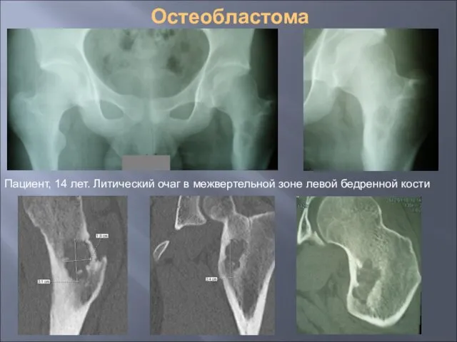Остеобластома Пациент, 14 лет. Литический очаг в межвертельной зоне левой бедренной кости