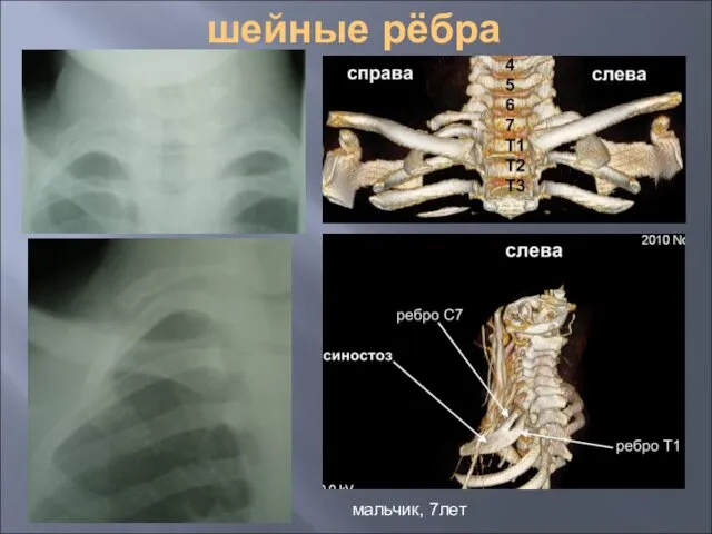 шейные рёбра мальчик, 7лет