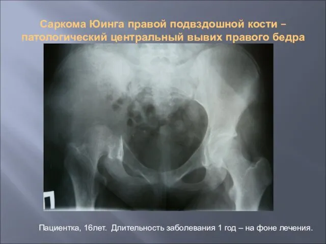 Саркома Юинга правой подвздошной кости – патологический центральный вывих правого