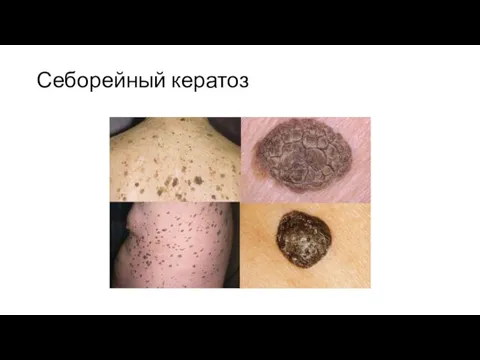 Себорейный кератоз