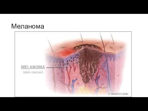 Меланома