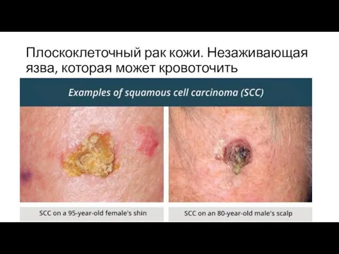 Плоскоклеточный рак кожи. Незаживающая язва, которая может кровоточить