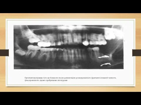 Ортопантомограмма того же больного после реплантации резецированного фрагмента нижней челюсти, фиксированного двумя серебряными лигатурами