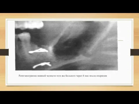 Рентгенограмма нижней челюс­ти того же больного через 6 мес после опе­рации